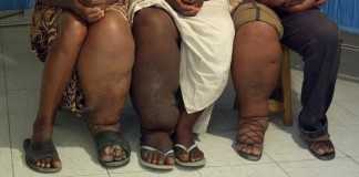 elephantiasis